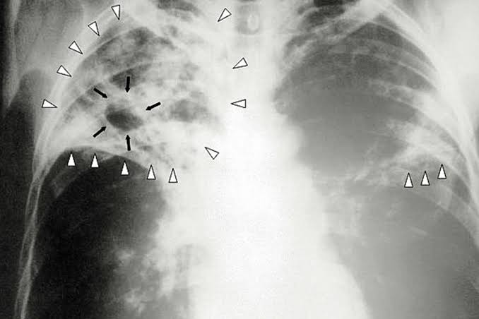'Age-old' disease hits 12-year high in Calif. as new outbreak details revealed