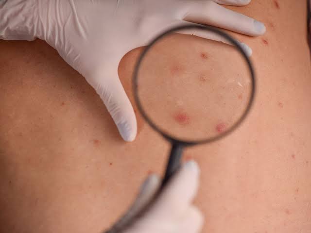 NHS issues urgent ‘check your skin’ warning for illness that kills thousands