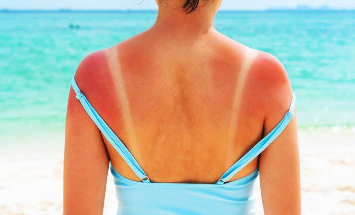 Scientists identify the main cause of sunburns, and now they have to rewrite the textbooks