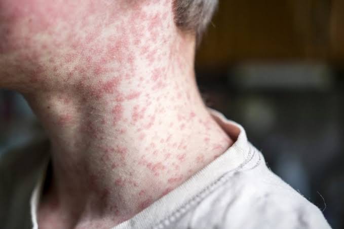 Measles exposure at Newark airport and hospital after first confirmed case