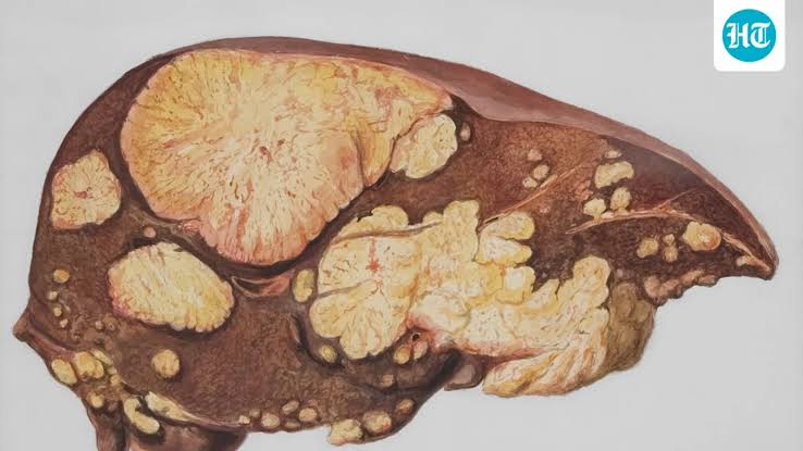 You may not drink alcohol, but is your liver still healthy? Hepatologist shares warning signs you could be ignoring | Health