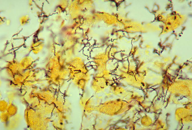 Key Discovery Could Be a 'Valuable Starting Point' To Saving Children from Deadly Disfiguring Condition