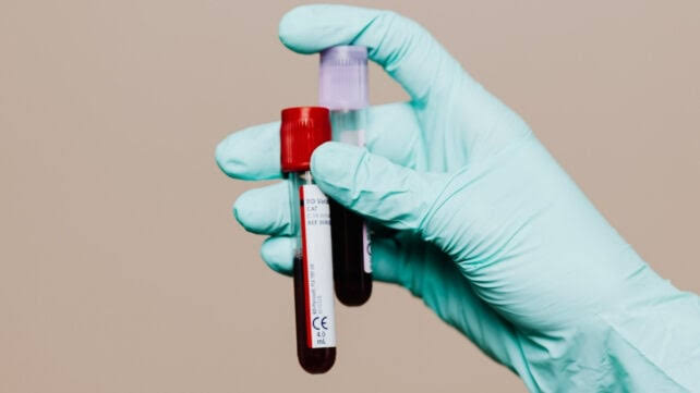 Blood Tests Could Reveal Alzheimer's Risk Years Before Symptoms Appear