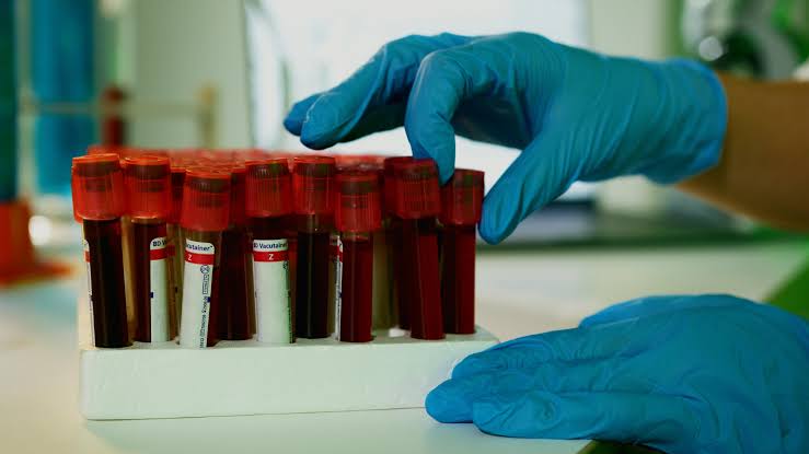 Little-used cholesterol test could prevent more heart attacks and strokes