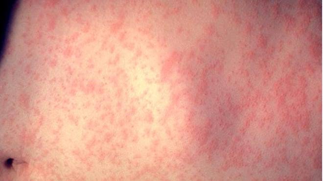 Maricopa County reports another measles case and exposure site in Mesa