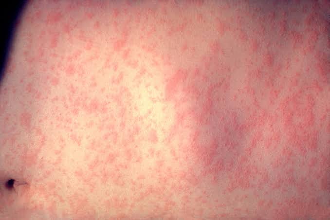 Latest Oregon measles exposure sites: 2 Salem-area businesses