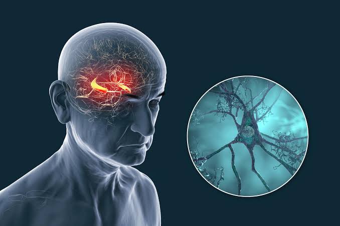 New Study Challenges Alzheimer’s Theories: It’s Not Just About Plaques