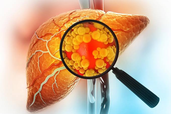 New AI Blood Test Detects Silent Liver Disease Before Symptoms Appear