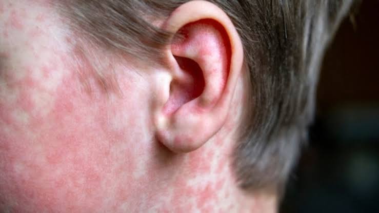 Possible measles exposure reported at the Boise Airport