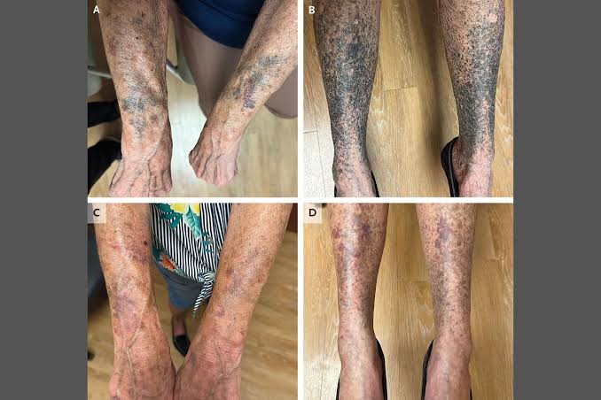 Antibiotics Turned This Woman’s Limbs Into an Unsettling Horrorshow