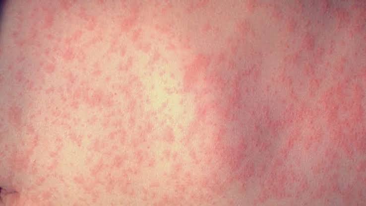 Health officials warn of measles exposure at Mt. Hood Community College campus in Gresham
