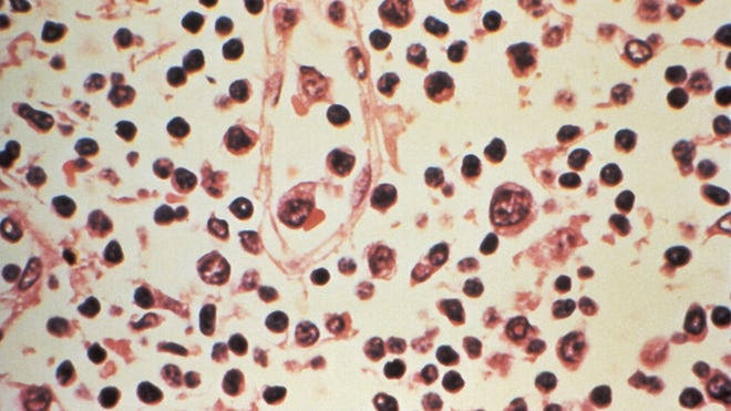 Health officials monitoring potential hantavirus infections in at least 3 states