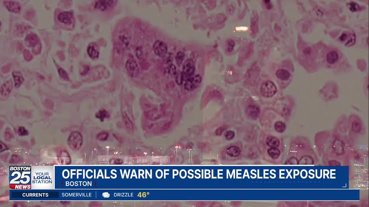 Traveler with measles recently passed through Boston’s Logan Airport, officials warn
