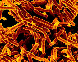 New low-cost test may transform tuberculosis detection worldwide