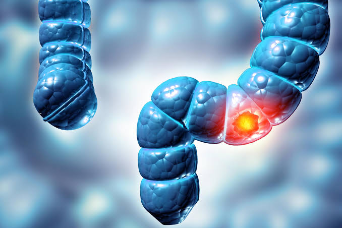 Scientists Discover Hidden Virus Linked to Colorectal Cancer