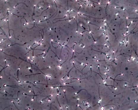 Man produces sperm from testicular tissue frozen as a child in breakthrough trial
