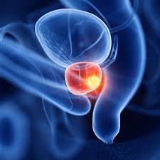 Metformin May Mimic Exercise Signals in Prostate Cancer Care