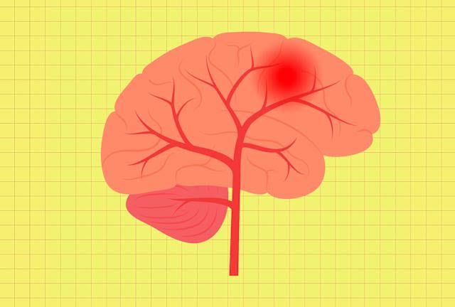 3 Surprising Habits That Could Raise Your Stroke Risk, According to a Neurologist