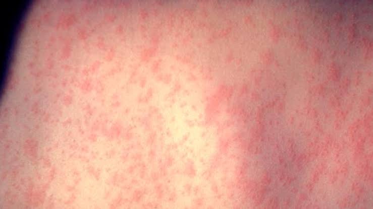 Hospital Measles Exposure