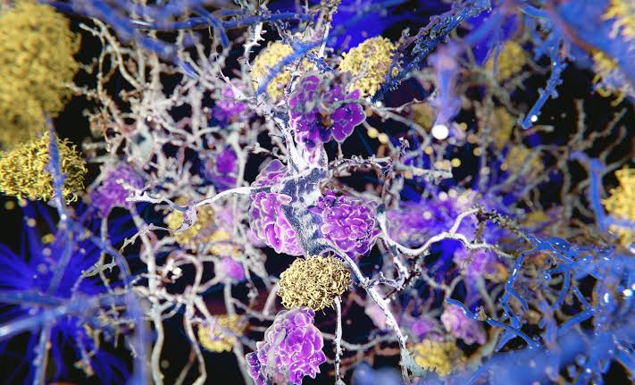Alzheimer's may start in body tissue inflammation, not in the brain