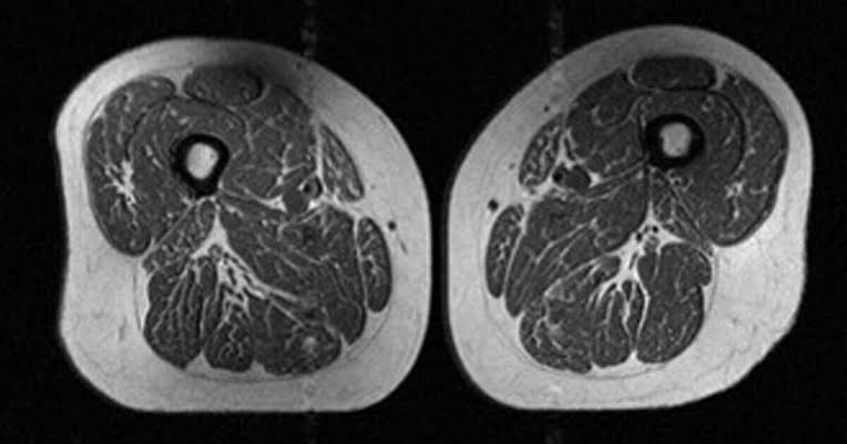 Alarming image exposes the effect ultra-processed foods have on bodies