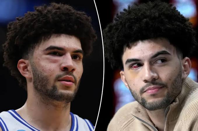 Cameron Boozer suffered multiple facial fractures in Duke’s Elight Eight loss to UConn