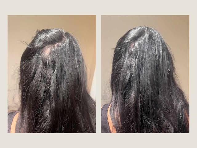 A Reviewer Saw “3 Inches of Growth” Thanks to This LED Device—and a Dermatologist Told Me How It Works