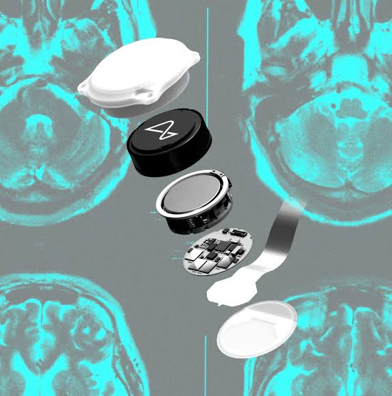 Did Neuralink make the wrong bet?