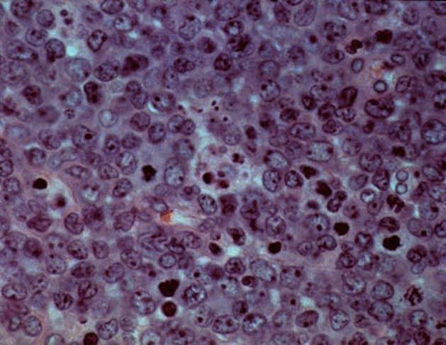 Allogene Therapeutics’ CAR-T treatment eliminates residual cancer cells in B-cell lymphoma patients