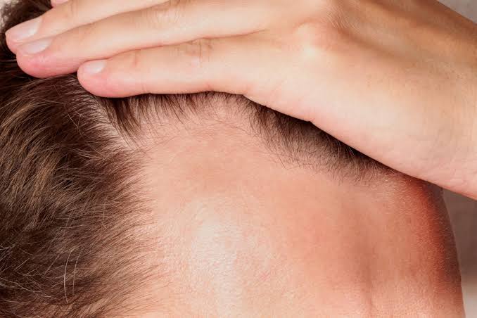 ‘Rogaine’ in a Pill? Oral Minoxidil Aces Major Hair Loss Trial