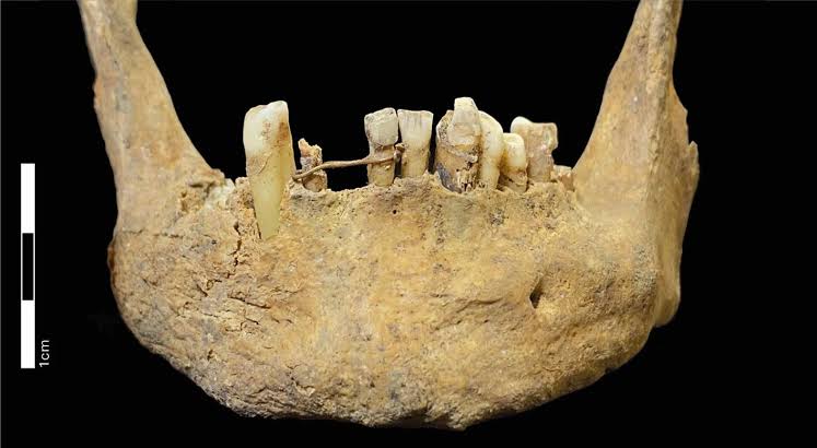 Medieval jaw reveals Scotland's first known dental bridge made from 20-carat gold