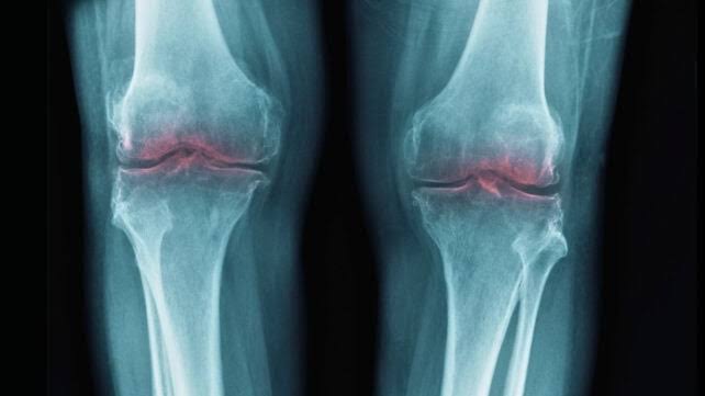 Breakthrough to Restore Aging Joints Could Help Treat Osteoarthritis