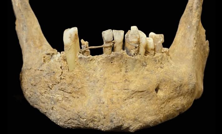 500-Year-Old Gold Dental Implant Unearthed In Scotland Reveals Surprisingly Advanced Medieval Dentistry